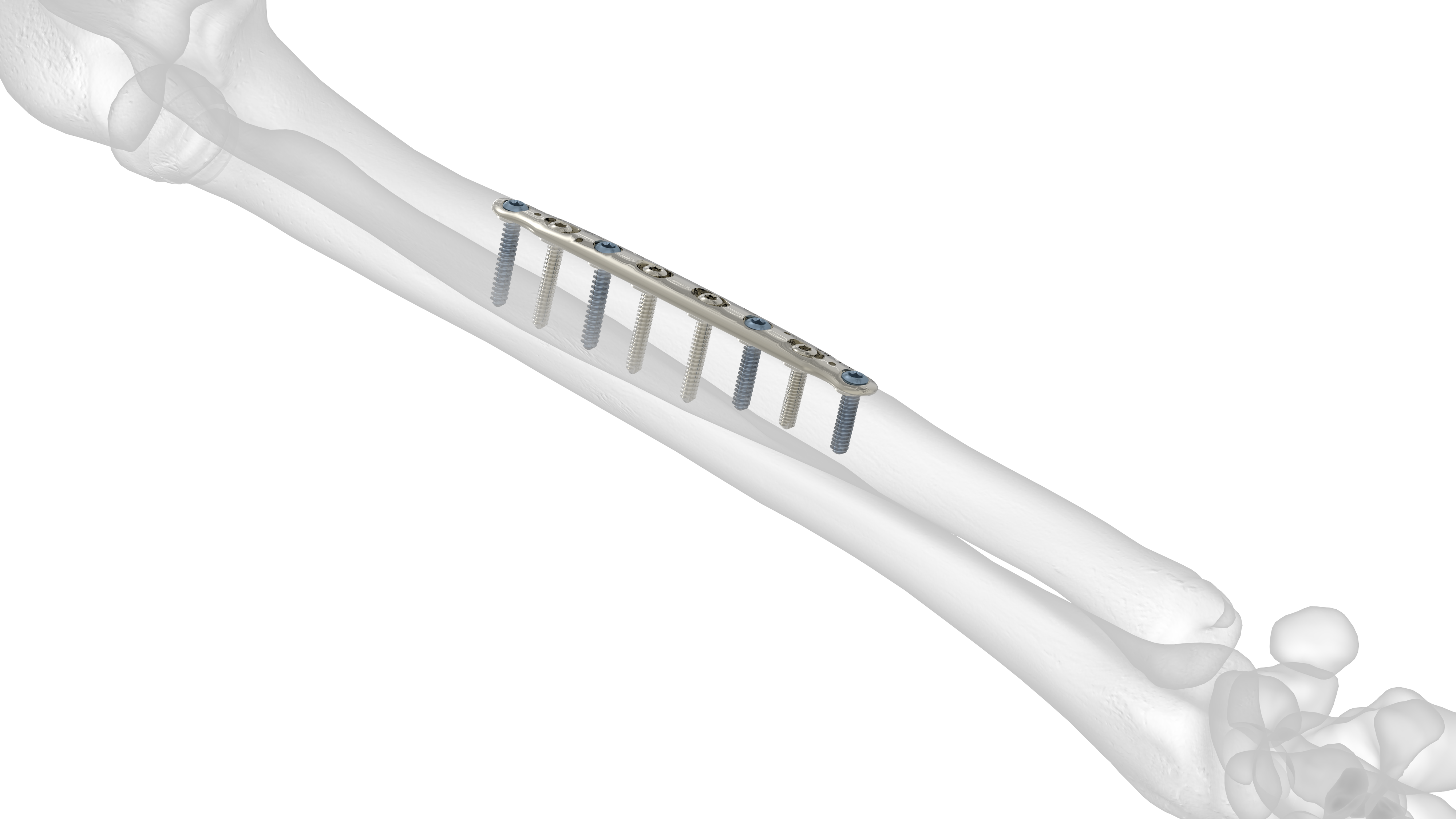 Midshaft Ulna Plate Acumed